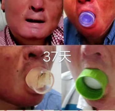 回归本源，让疤痕收回本该易防易治的本来形象！