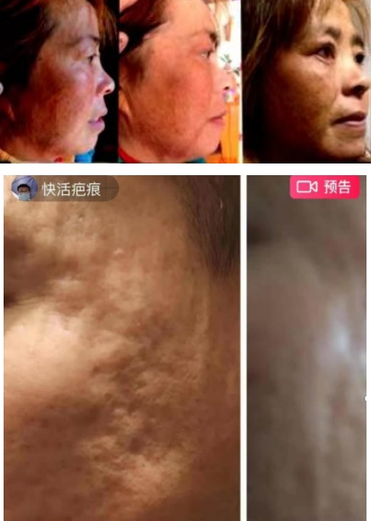 回归本源，让疤痕收回本该易防易治的本来形象！