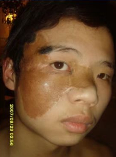 回归本源，让疤痕收回本该易防易治的本来形象！