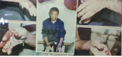 以身试药的中医传奇：刘中胜与他的烧伤康复“神膏”