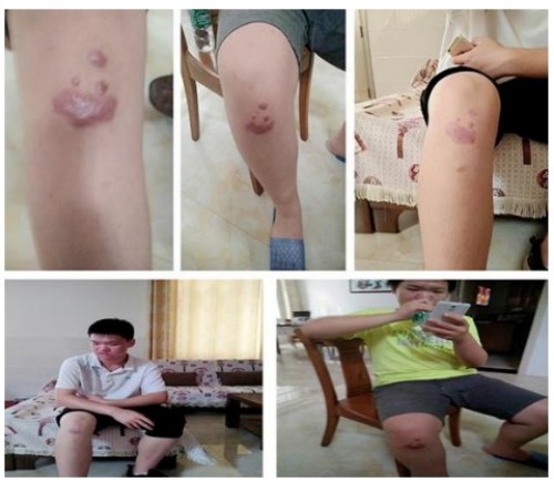 以身试药的中医传奇：刘中胜与他的烧伤康复“神膏”