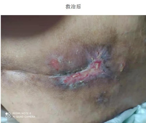 以身试药的中医传奇：刘中胜与他的烧伤康复“神膏”