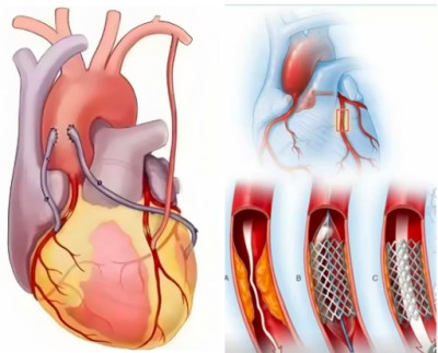 冠心病！世界医学研究难以治愈。中国发明！痊愈冠心病突破难关！