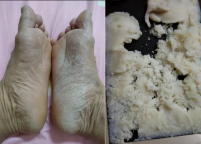 冠心病！世界医学研究难以治愈。中国发明！痊愈冠心病突破难关！