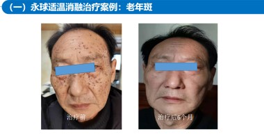 适温消融技术的临床应用与革新