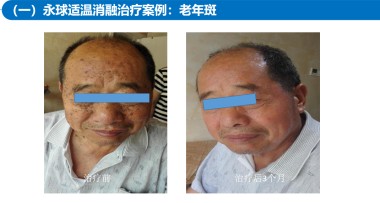 适温消融技术的临床应用与革新