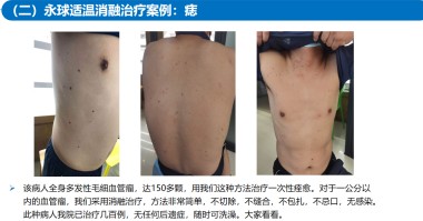 适温消融技术的临床应用与革新