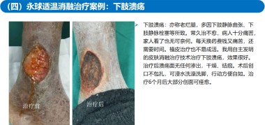 适温消融技术的临床应用与革新
