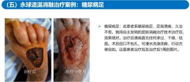 适温消融技术的临床应用与革新