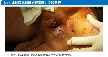 适温消融技术的临床应用与革新
