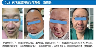 适温消融技术的临床应用与革新