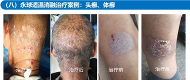 适温消融技术的临床应用与革新