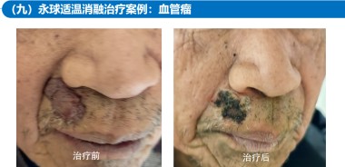 适温消融技术的临床应用与革新