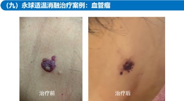 适温消融技术的临床应用与革新