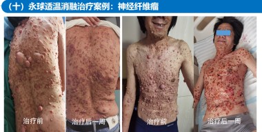 适温消融技术的临床应用与革新