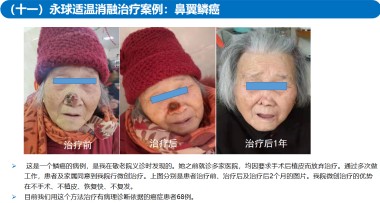 适温消融技术的临床应用与革新
