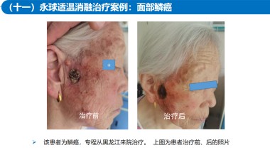 适温消融技术的临床应用与革新
