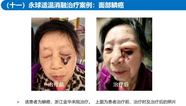 适温消融技术的临床应用与革新