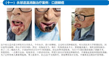 适温消融技术的临床应用与革新