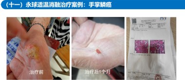 适温消融技术的临床应用与革新