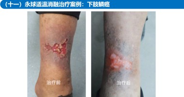 适温消融技术的临床应用与革新