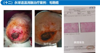 适温消融技术的临床应用与革新