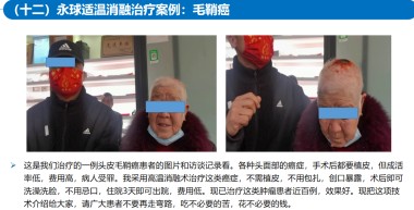 适温消融技术的临床应用与革新