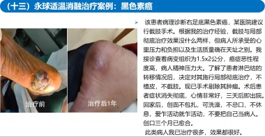 适温消融技术的临床应用与革新