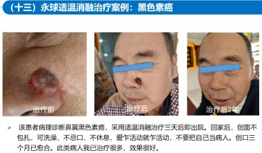 适温消融技术的临床应用与革新