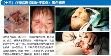 适温消融技术的临床应用与革新