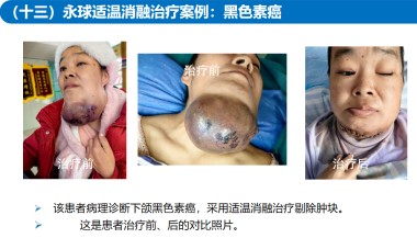 适温消融技术的临床应用与革新