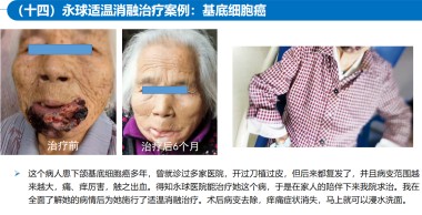 适温消融技术的临床应用与革新