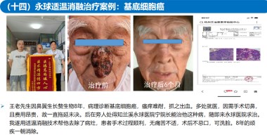 适温消融技术的临床应用与革新