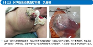 适温消融技术的临床应用与革新