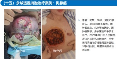 适温消融技术的临床应用与革新
