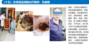 适温消融技术的临床应用与革新