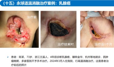 适温消融技术的临床应用与革新