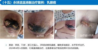 适温消融技术的临床应用与革新