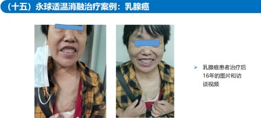 适温消融技术的临床应用与革新