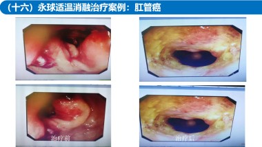 适温消融技术的临床应用与革新