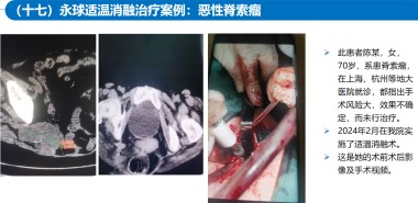 适温消融技术的临床应用与革新