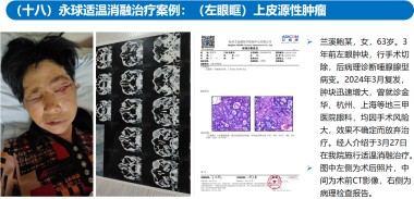 适温消融技术的临床应用与革新