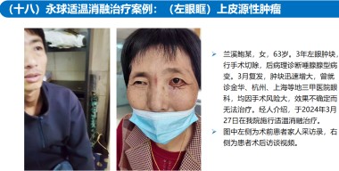 适温消融技术的临床应用与革新