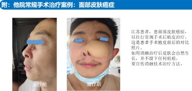 适温消融技术的临床应用与革新